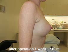 plastic-surgery-breast-augmentation 